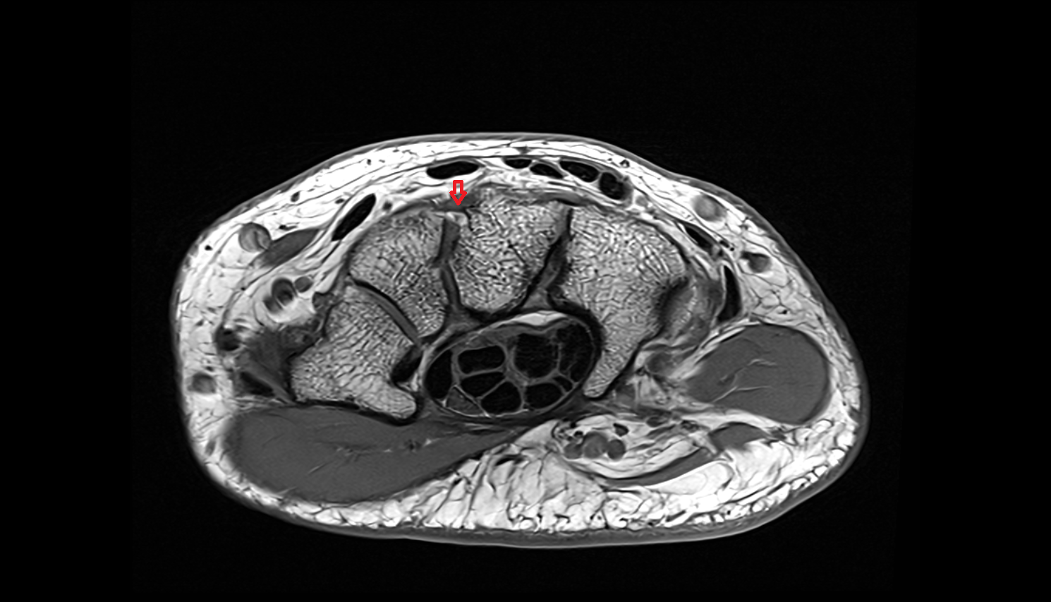Dorsal capitotrapezoid  ligament (Trapezocapitate ligament)  mri axial cross sectional anatomy 3T MRI AI enhanced radiology image-img-00000-00000_00001