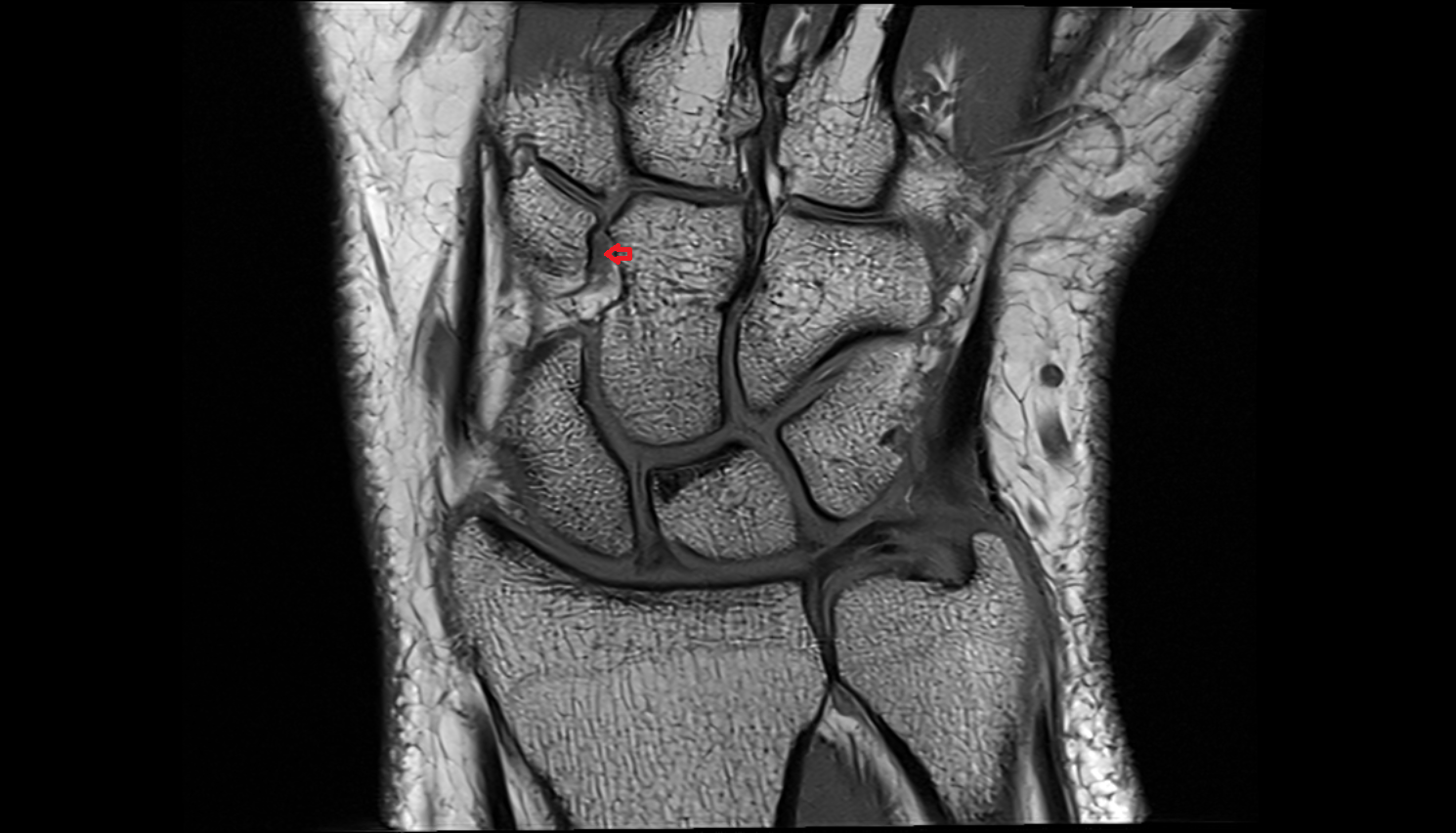 Dorsal capitotrapezoid  ligament (Trapezocapitate ligament)  mri coronal cross sectional anatomy 3T MRI AI enhanced radiology image-img-00000-00000