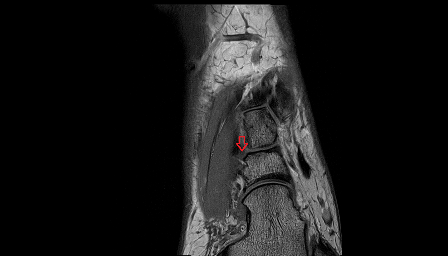 Dorsal cuneonavicular ligaments coronal cross sectional anatomy 3T MRI AI enhanced radiology image-img-00000-00000