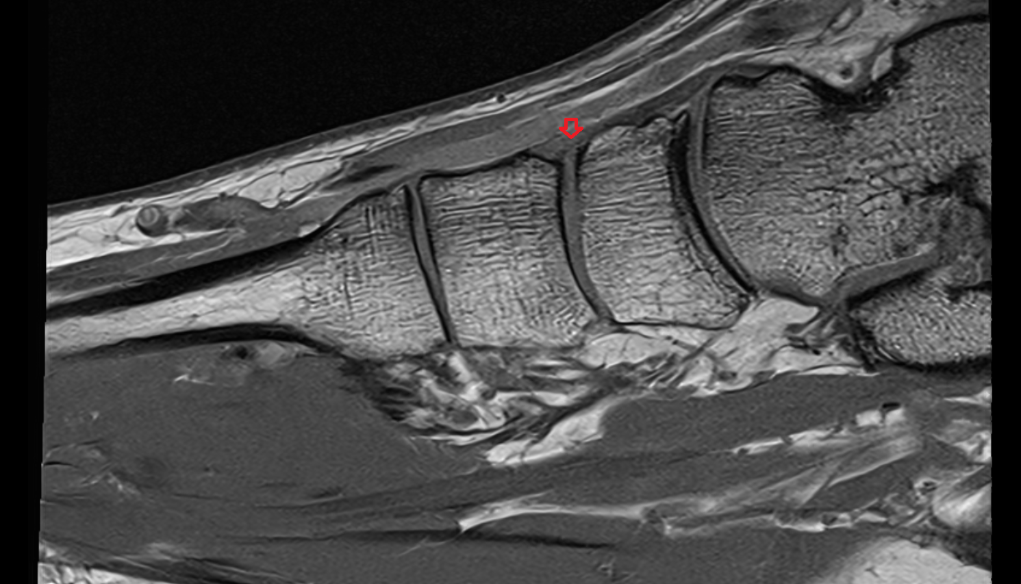 Dorsal cuneonavicular ligaments sagittal cross sectional anatomy 3T MRI AI enhanced radiology image-img-00000-00000