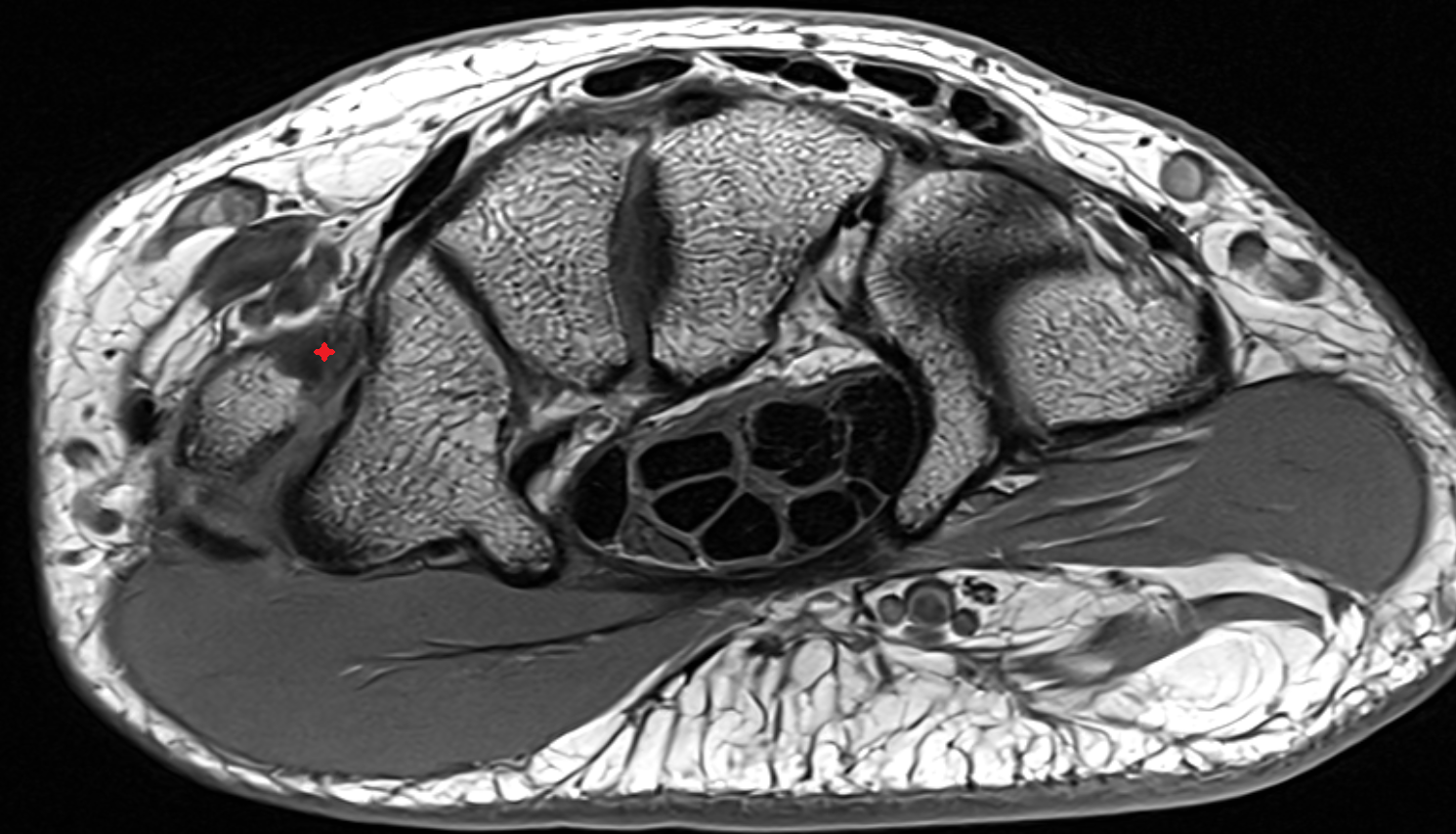 Dorsal deltoid ligament  axial cross sectional anatomy 3T MRI AI enhanced radiology image-img-00000-00000