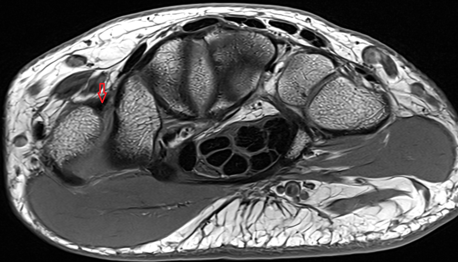 Dorsal deltoid ligament  axial cross sectional anatomy 3T MRI AI enhanced radiology image-img-00000-00000_00001