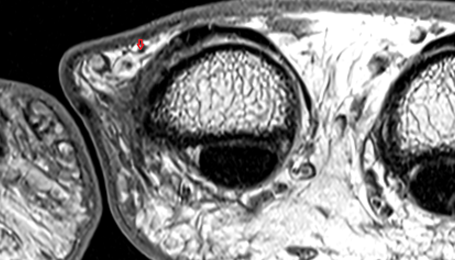 Dorsal digital arteries MRI axial  image-img-00000-00000