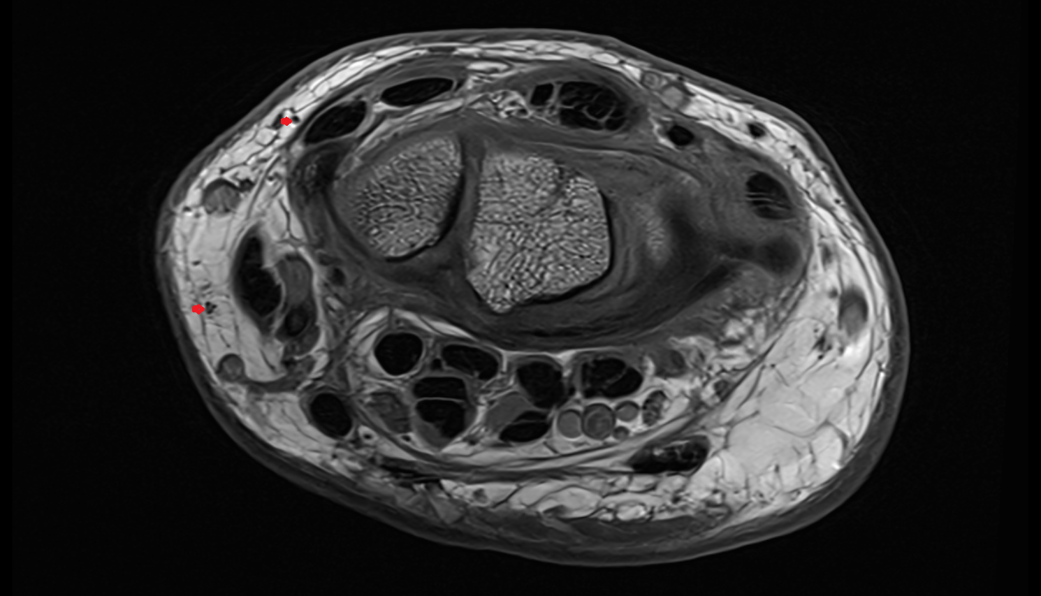 Dorsal digital branches of radial nerve axial cross sectional anatomy 3T MRI AI enhanced radiology image-img-00000-00000_00001