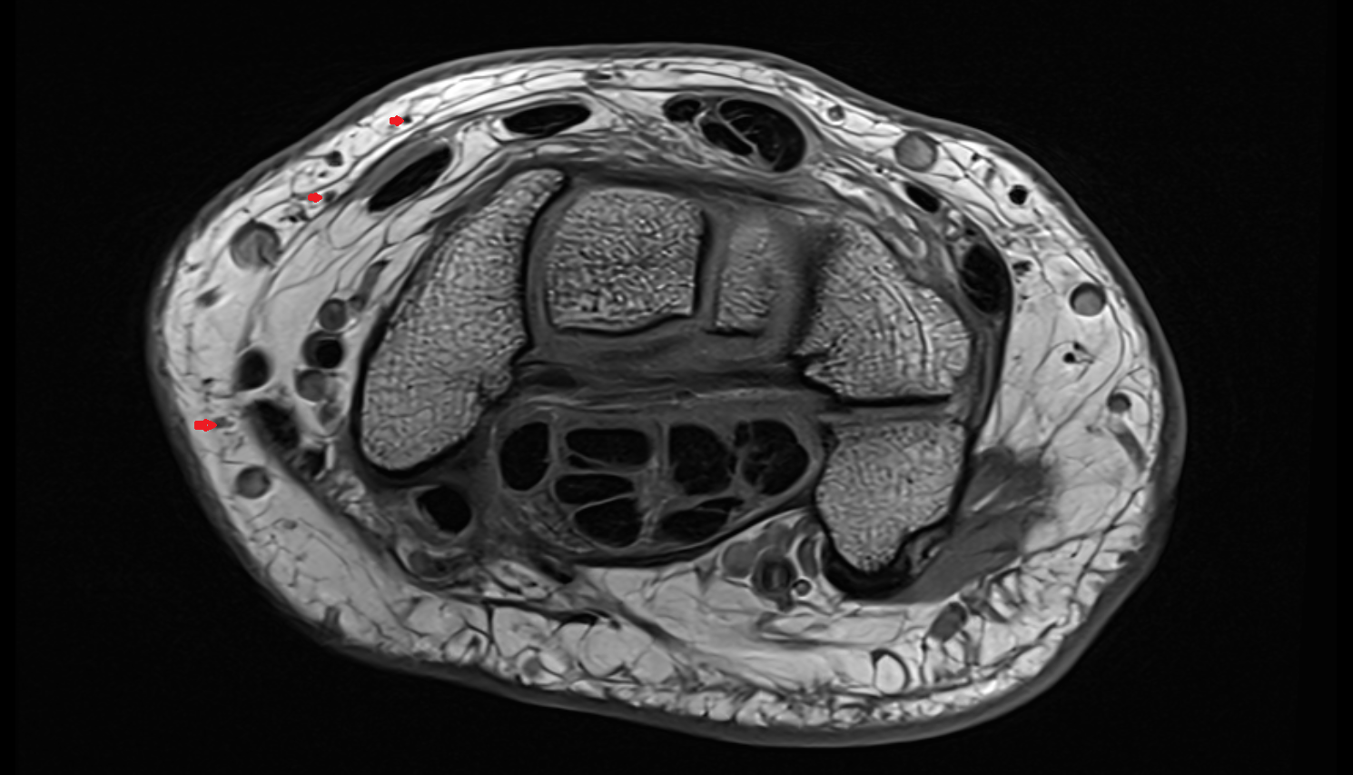Dorsal digital branches of radial nerve axial cross sectional anatomy 3T MRI AI enhanced radiology image-img-00000-00000_00002