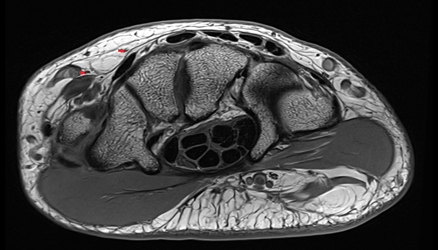 Dorsal digital branches of radial nerve axial cross sectional anatomy 3T MRI AI enhanced radiology image-img-00000-00000_00003