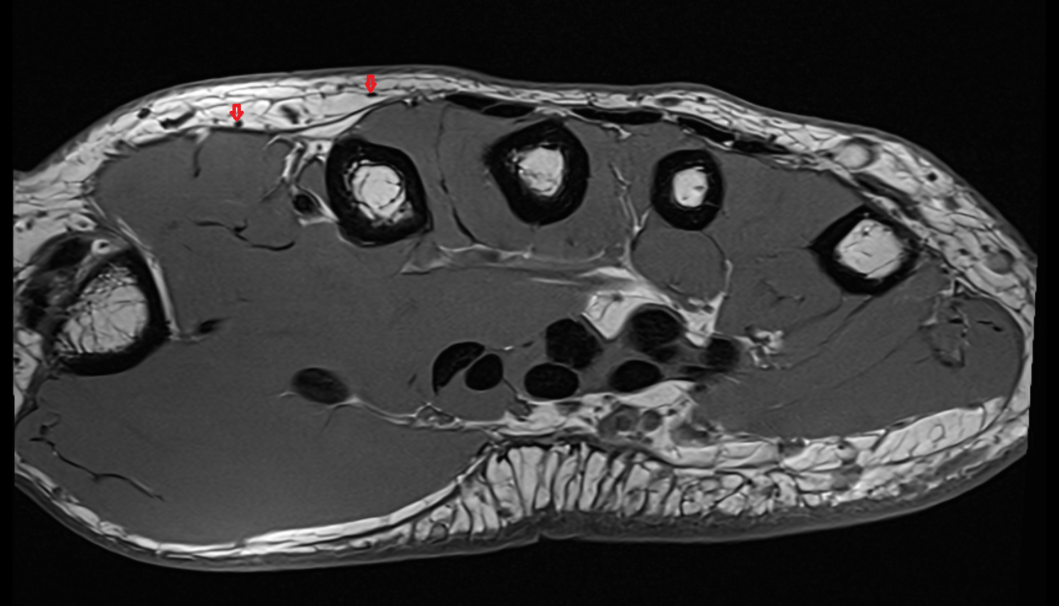 Dorsal digital branches of radial nerve axial cross sectional anatomy 3T MRI AI enhanced radiology image-img-00000-00000_00004