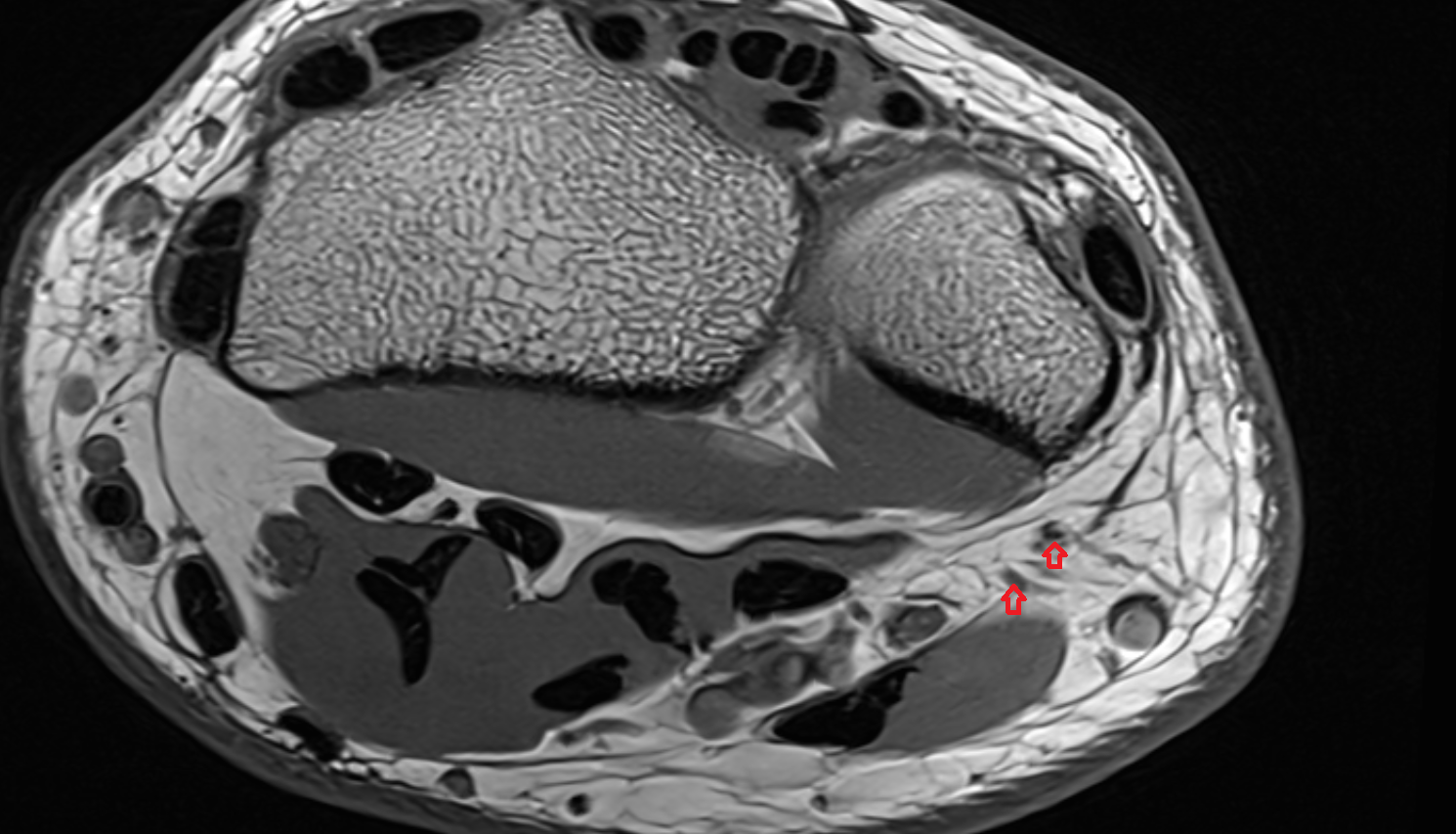 Dorsal digital branch of ulnar nerve axial cross sectional anatomy 3T MRI AI enhanced radiology image-img-00000-00000_00001