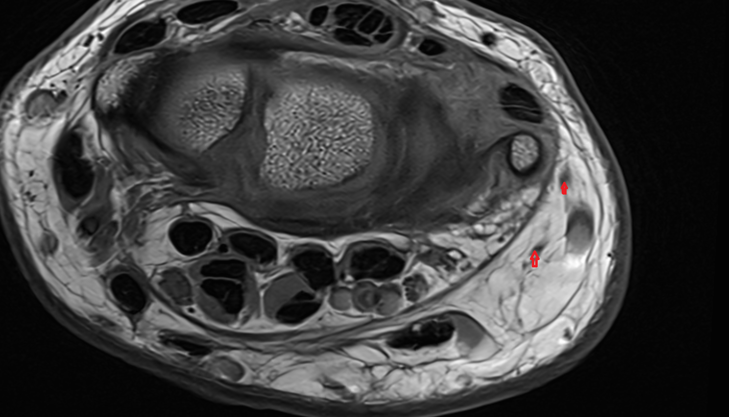 Dorsal digital branch of ulnar nerve axial cross sectional anatomy 3T MRI AI enhanced radiology image-img-00000-00000_00002