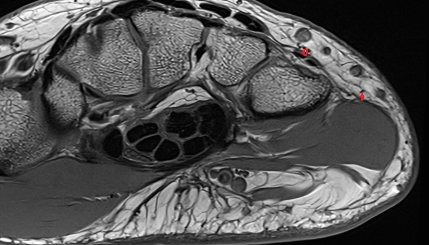 Dorsal digital branch of ulnar nerve axial cross sectional anatomy 3T MRI AI enhanced radiology image-img-00000-00000_00004