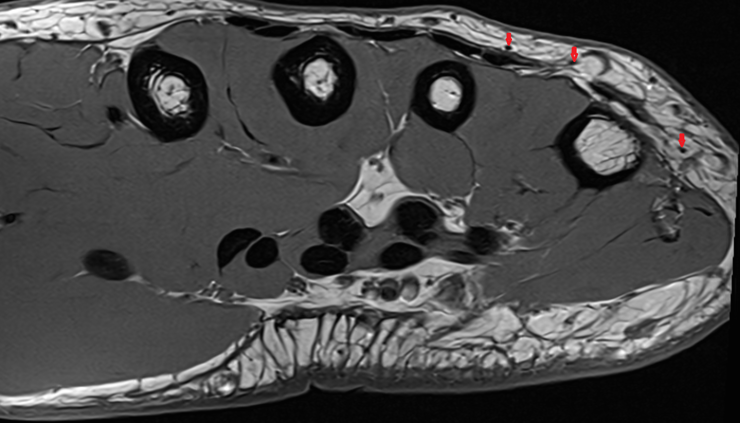 Dorsal digital branch of ulnar nerve axial cross sectional anatomy 3T MRI AI enhanced radiology image-img-00000-00000_00005