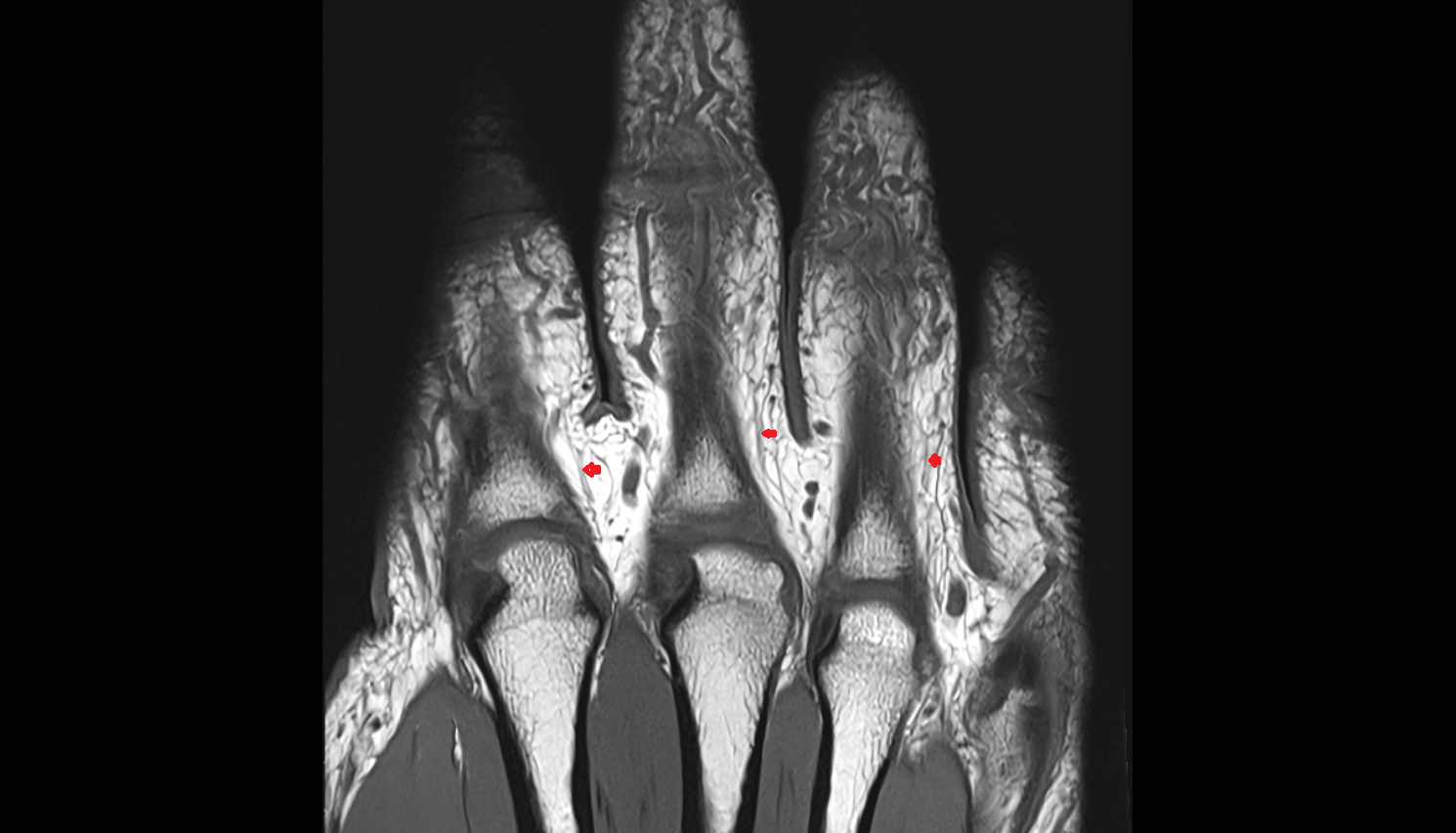 Dorsal digital nerve  MRI coronal image-img-00000-00000