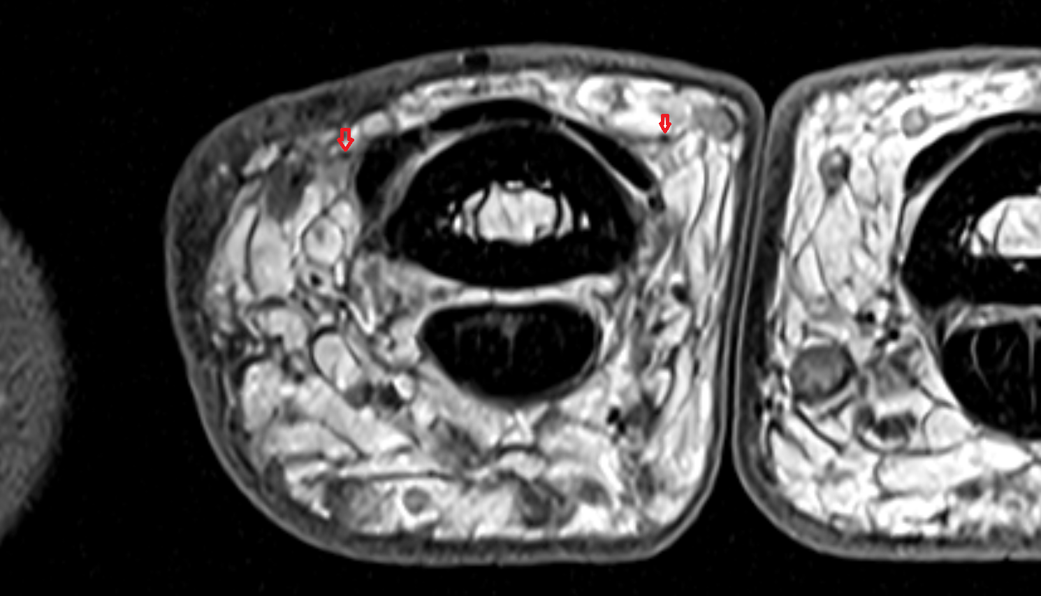 Dorsal digital nerve  hand  MRI axial  image-img-00000-00000