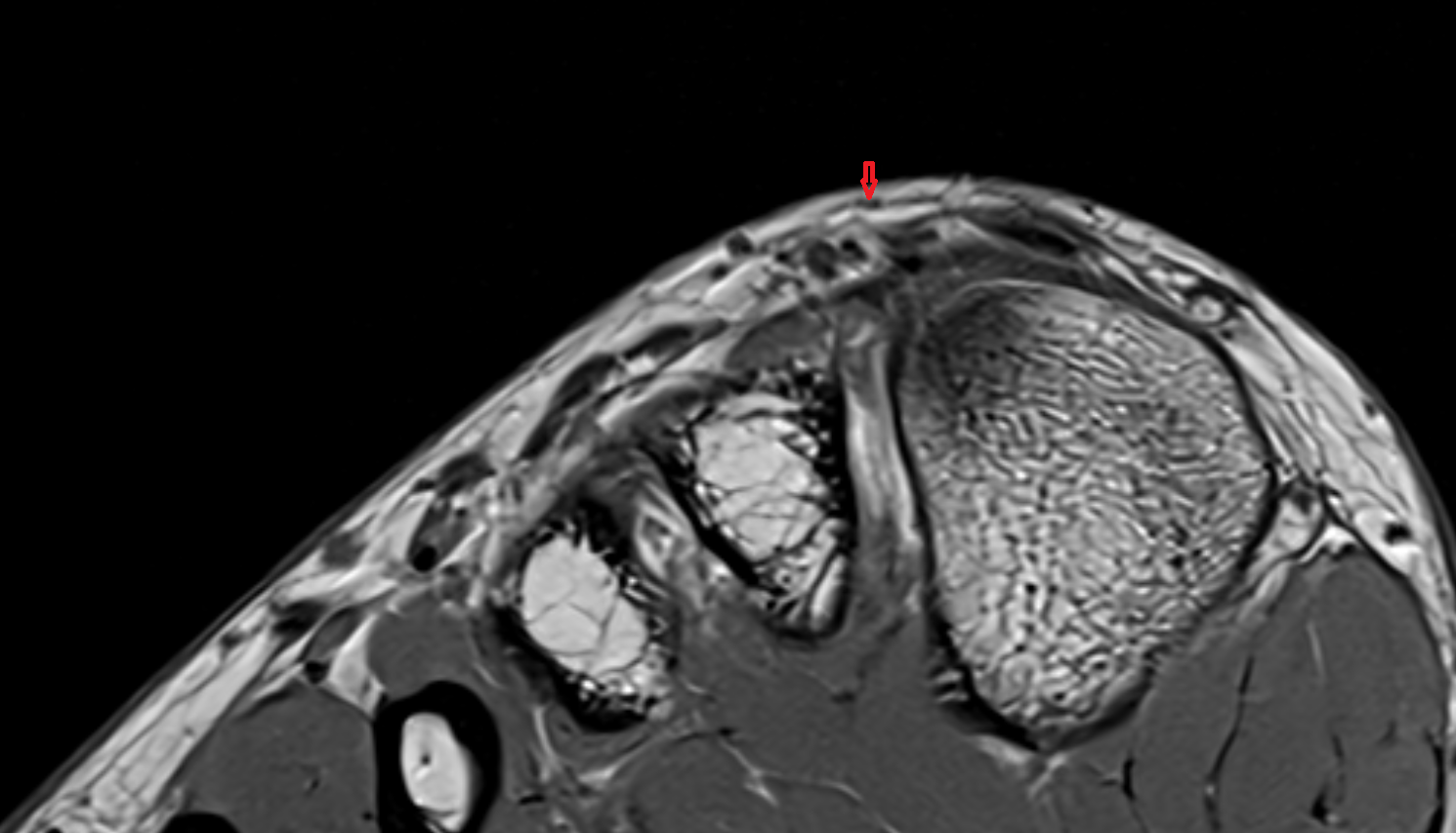 Dorsal digital nerve of foot axial cross sectional anatomy 3T MRI AI enhanced radiology image-img-00000-00000