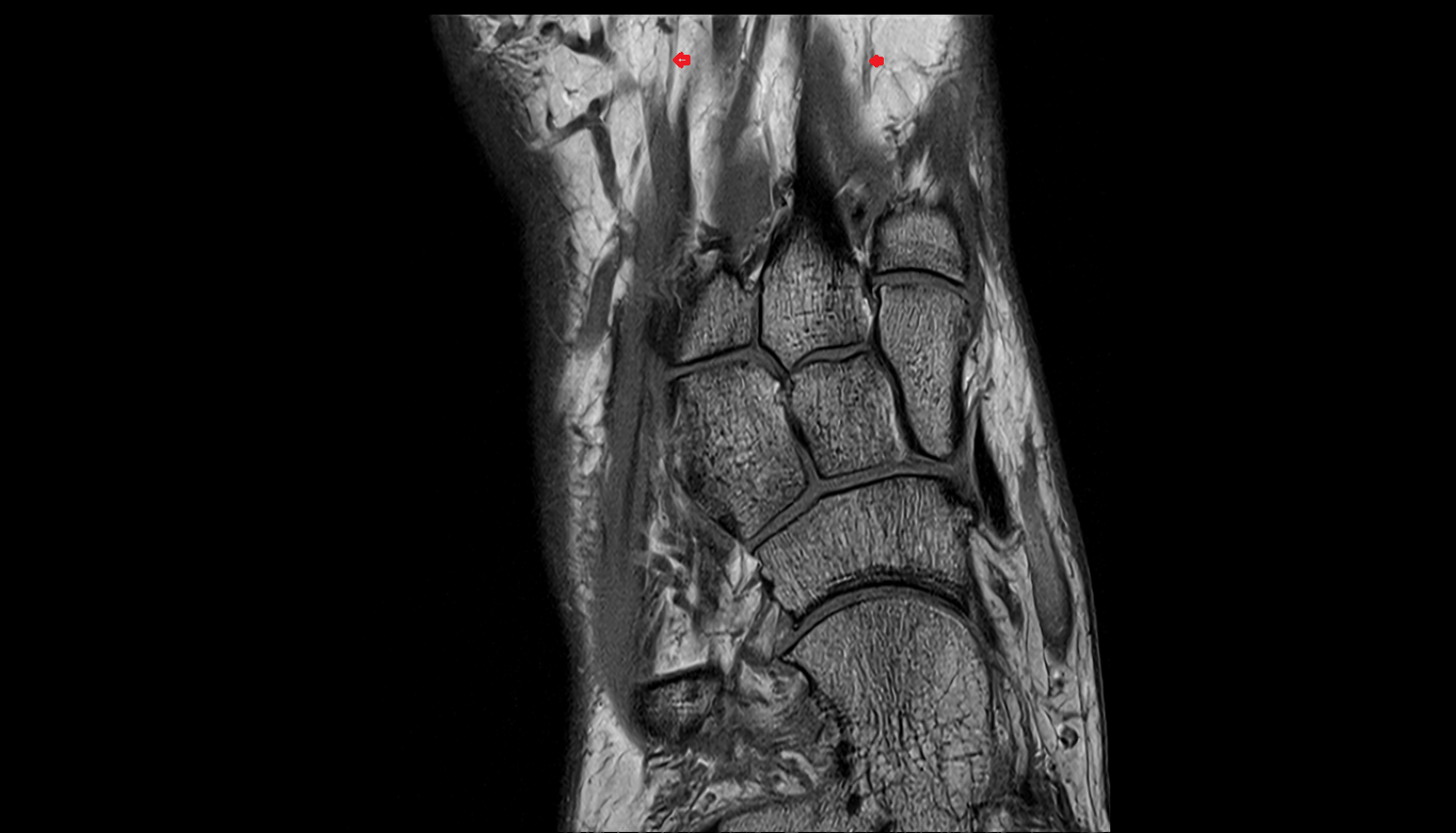 Dorsal digital nerve of foot axial cross sectional anatomy 3T MRI AI enhanced radiology image-img-00000-00000_00001