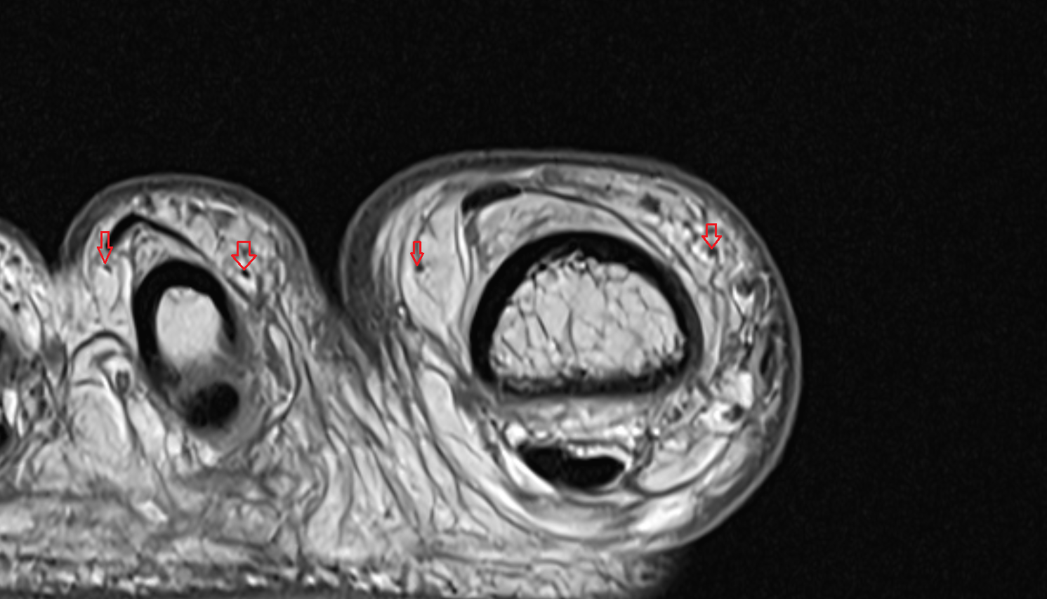 Dorsal digital nerves of foot axial cross sectional anatomy 3T MRI AI enhanced radiology image-img-00000-00000