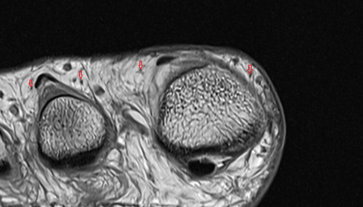 Dorsal digital nerves of foot axial cross sectional anatomy 3T MRI AI enhanced radiology image-img-00000-00000_00001