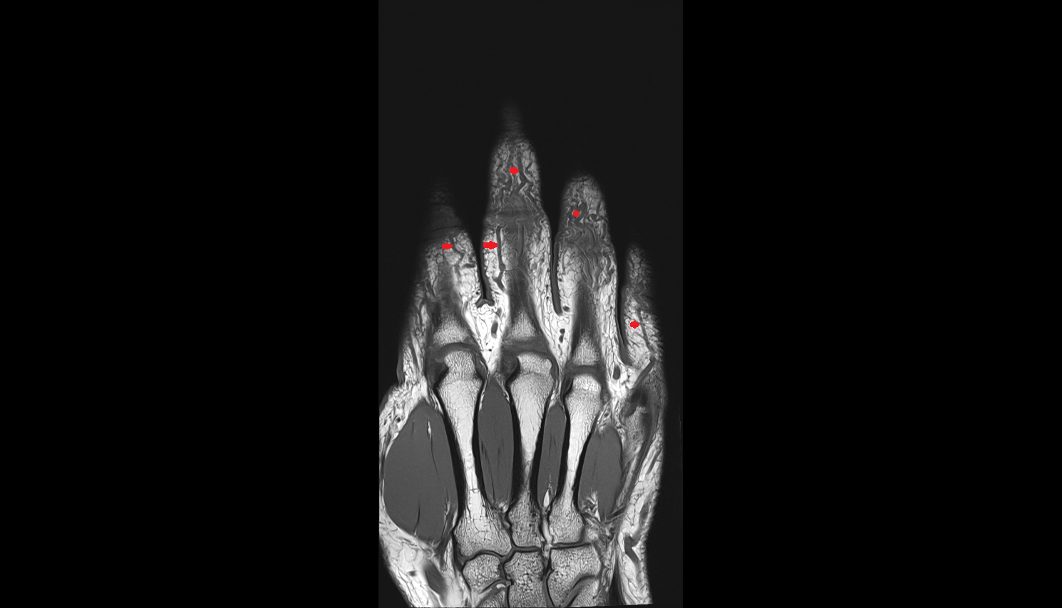 Dorsal digital veins  MRI coronal image-img-00000-00000