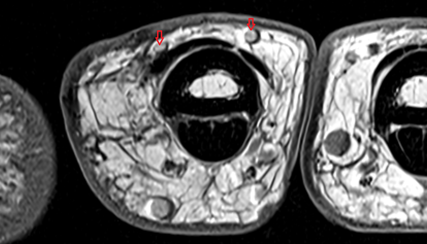 Dorsal digital veins  hand  MRI axial  image-img-00000-00000