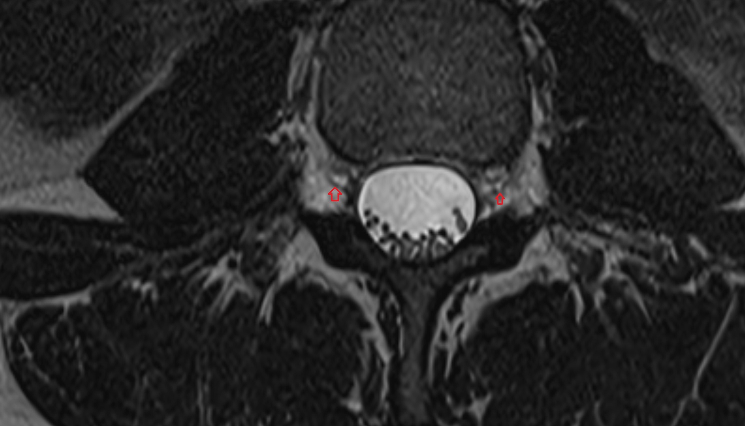 Dorsal exiting nerve root  MRI axial  anatomy  image-img-00000-00000