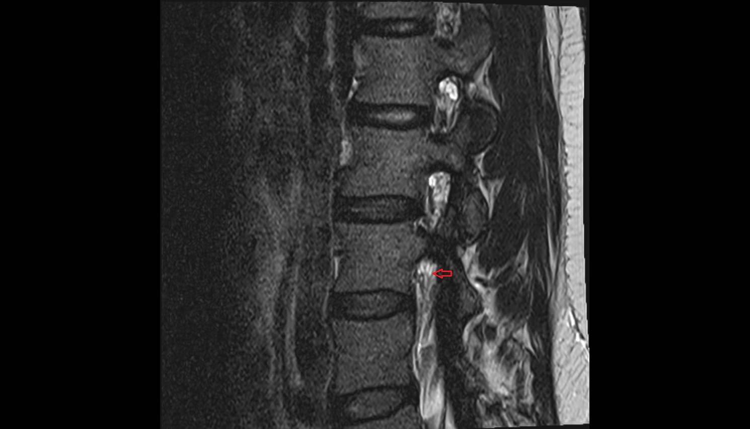 Dorsal exiting nerve root  MRI sagittal  anatomy  image-img-00000-00000