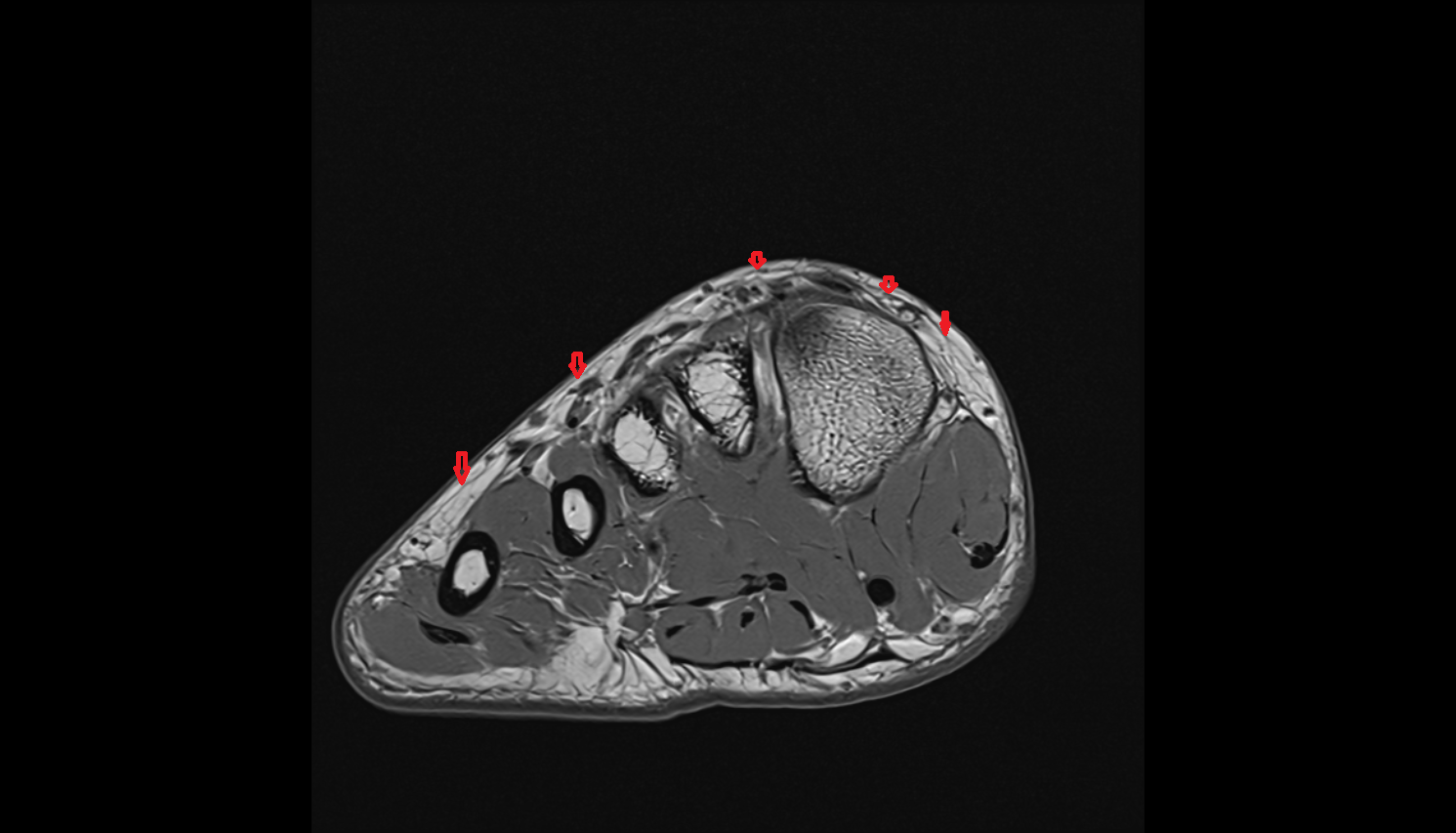 Dorsal fascia of foot coronal cross sectional anatomy 3T MRI AI enhanced radiology image-img-00000-00000