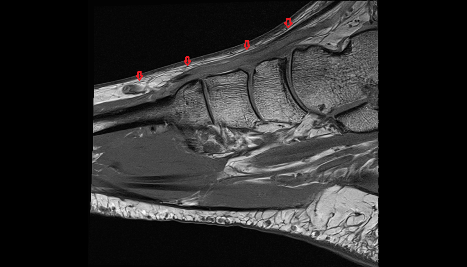 Dorsal fascia of foot sagittal cross sectional anatomy 3T MRI AI enhanced radiology image-img-00000-00000_00001