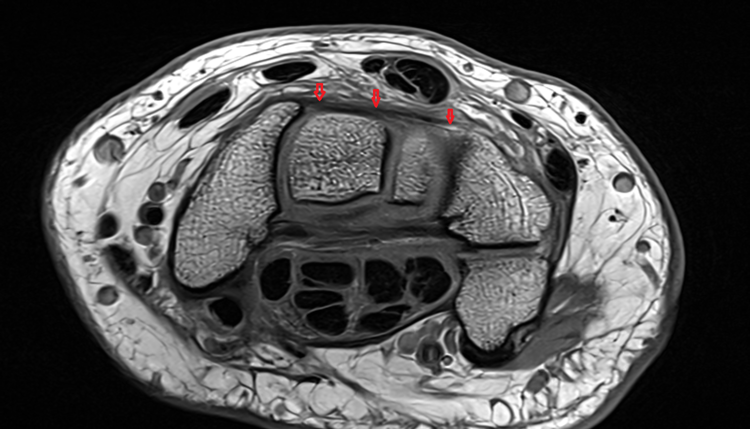 Dorsal intercarpal ligaments  mri axial cross sectional anatomy 3T MRI AI enhanced radiology image-img-00000-00000