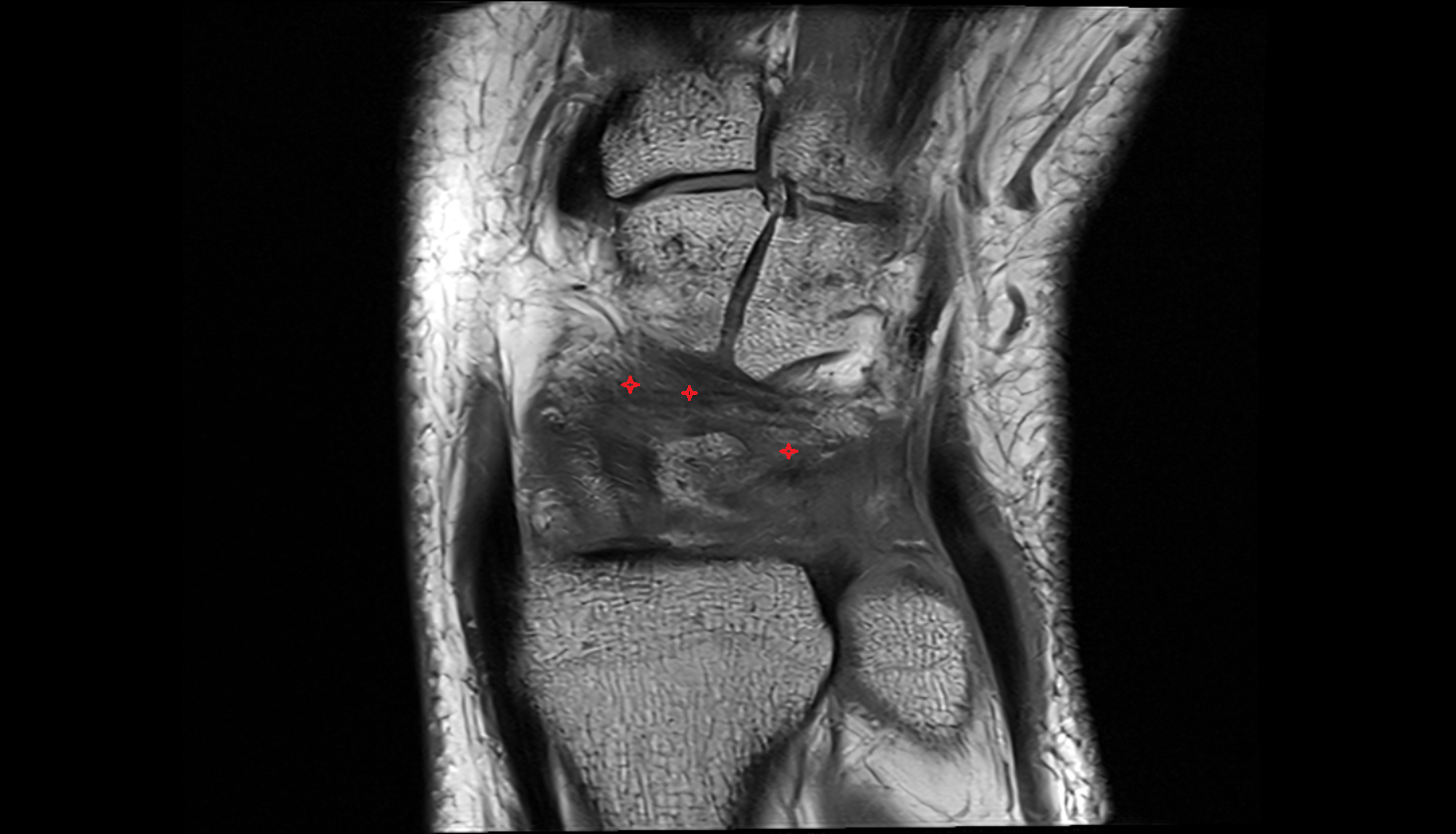 Dorsal intercarpal ligaments  mri coronal cross sectional anatomy 3T MRI AI enhanced radiology image-img-00000-00000