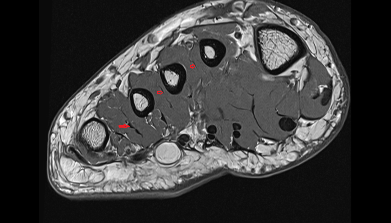 Dorsal interossei tendons of foot  sfov  of the Foot axial cross sectional anatomy 3T MRI AI enhanced radiology image-img-00000-00000