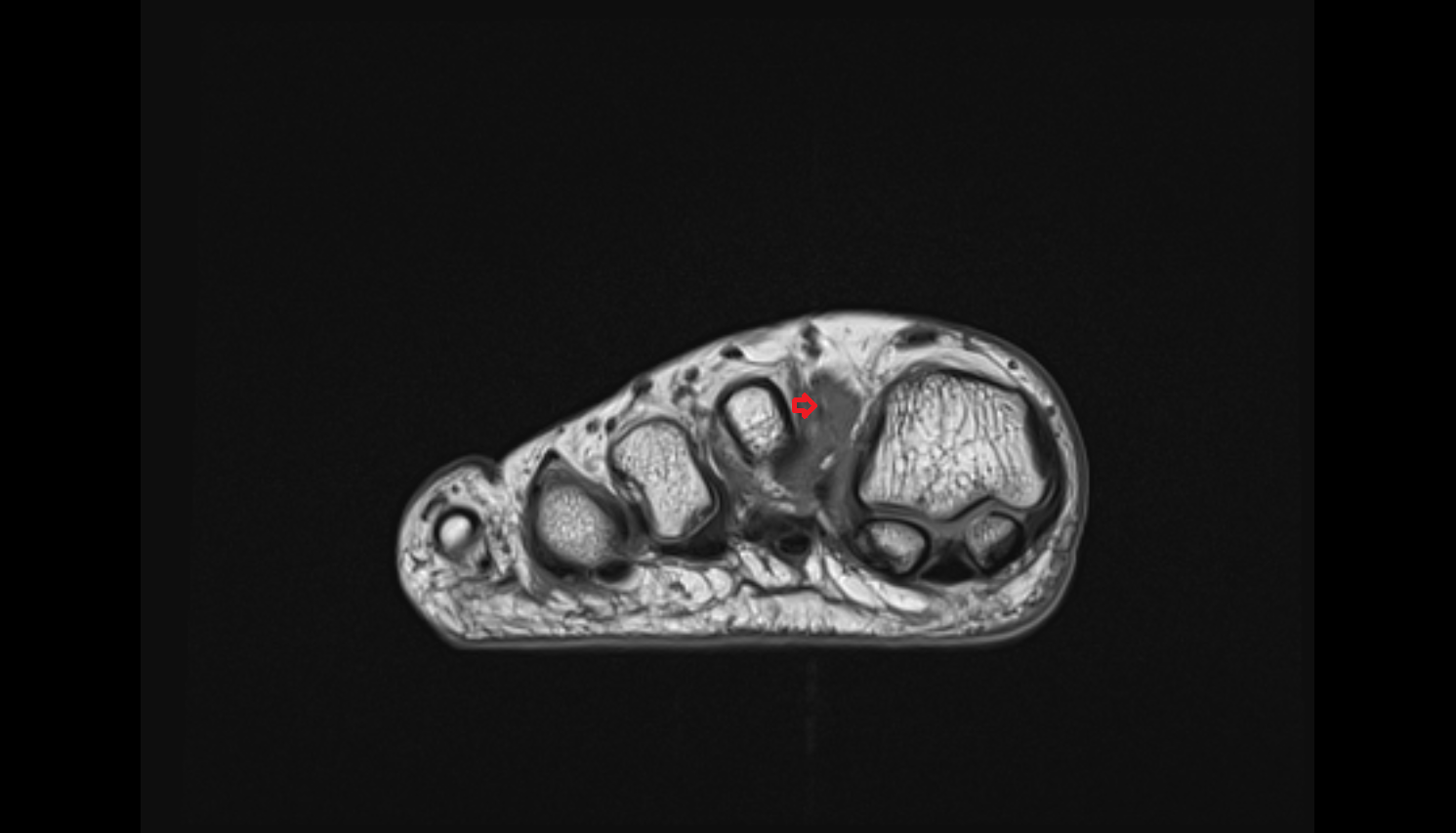Dorsal interossei tendons of foot  sfov  of the Foot axial cross sectional anatomy 3T MRI AI enhanced radiology image-img-00000-00000_00001