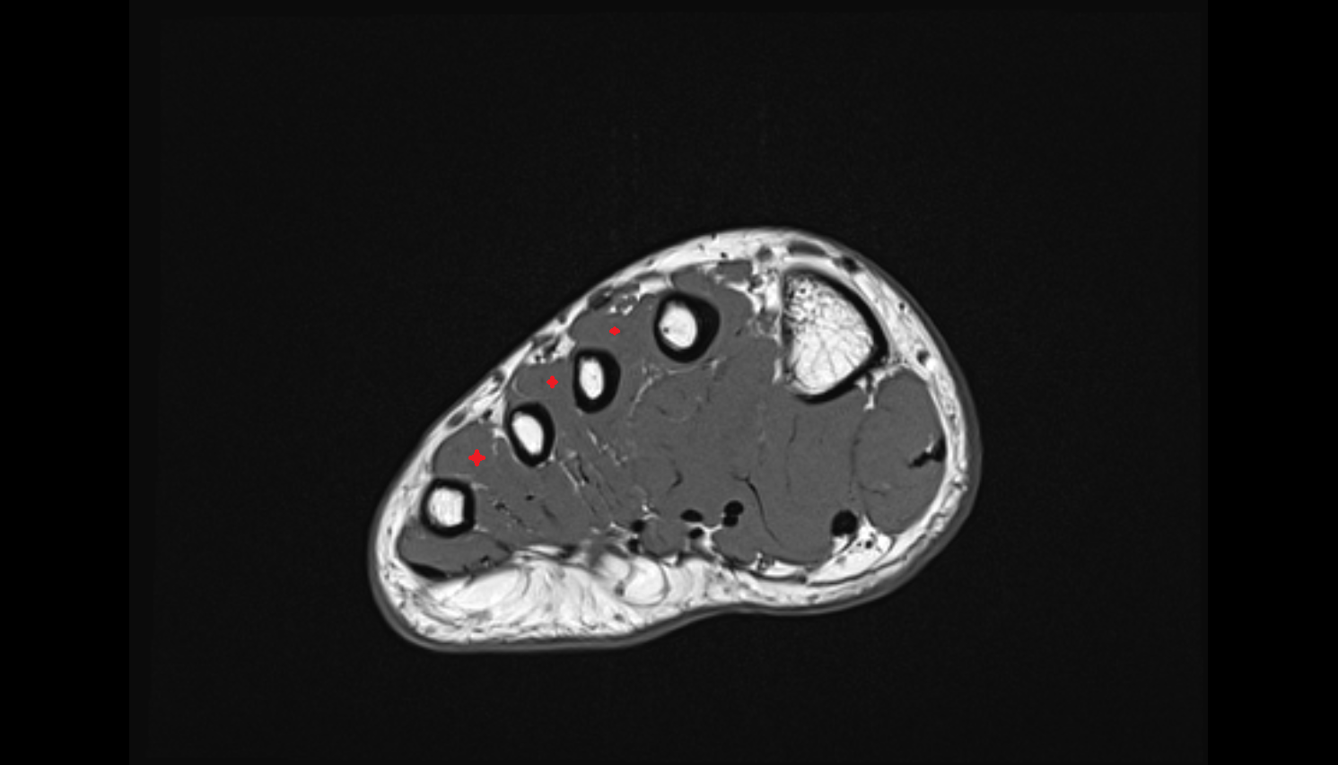 Dorsal interosseous muscles AXIAL cross sectional anatomy 3T MRI AI enhanced radiology image-img-00000-00000