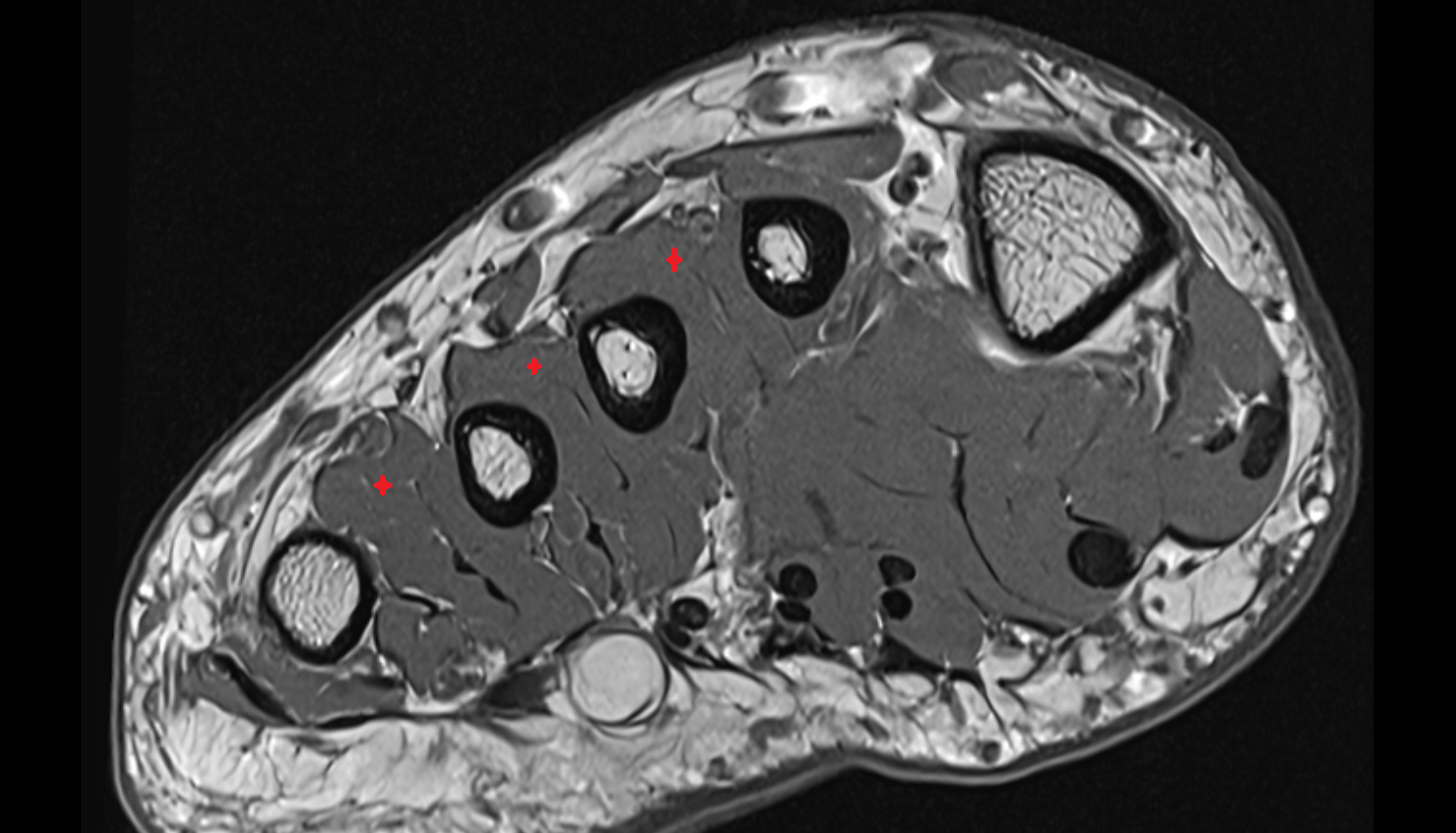 Dorsal interosseous muscles AXIAL cross sectional anatomy 3T MRI AI enhanced radiology image-img-00000-00000_00001