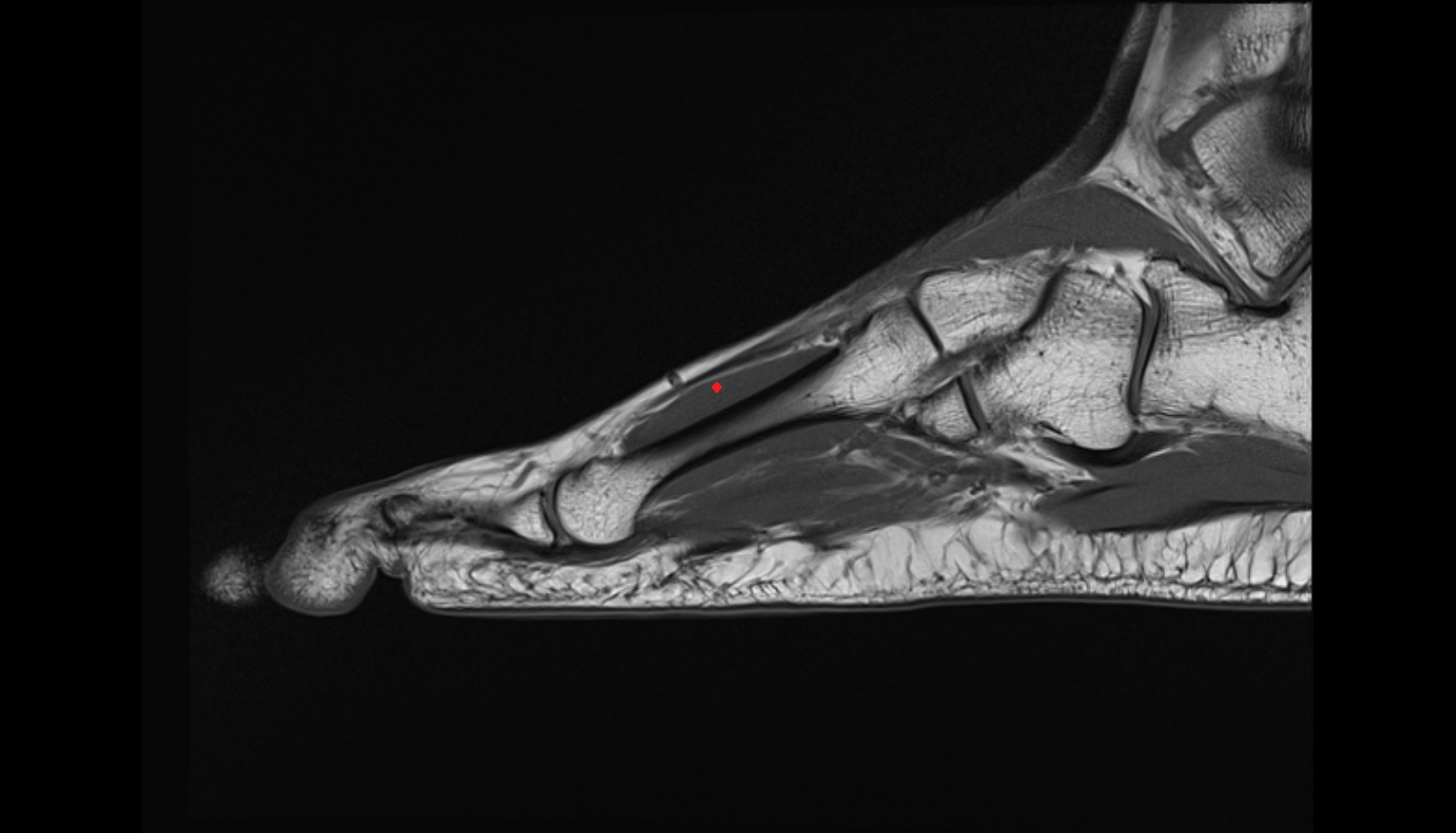 Dorsal interosseous muscles AXIAL cross sectional anatomy 3T MRI AI enhanced radiology image-img-00000-00000_00003