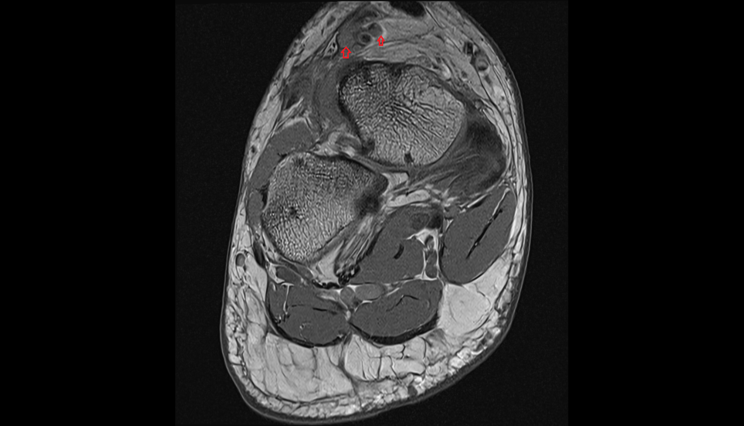 Dorsalis pedis veins  of foot  axial cross sectional anatomy 3T MRI AI enhanced radiology image-img-00000-00000