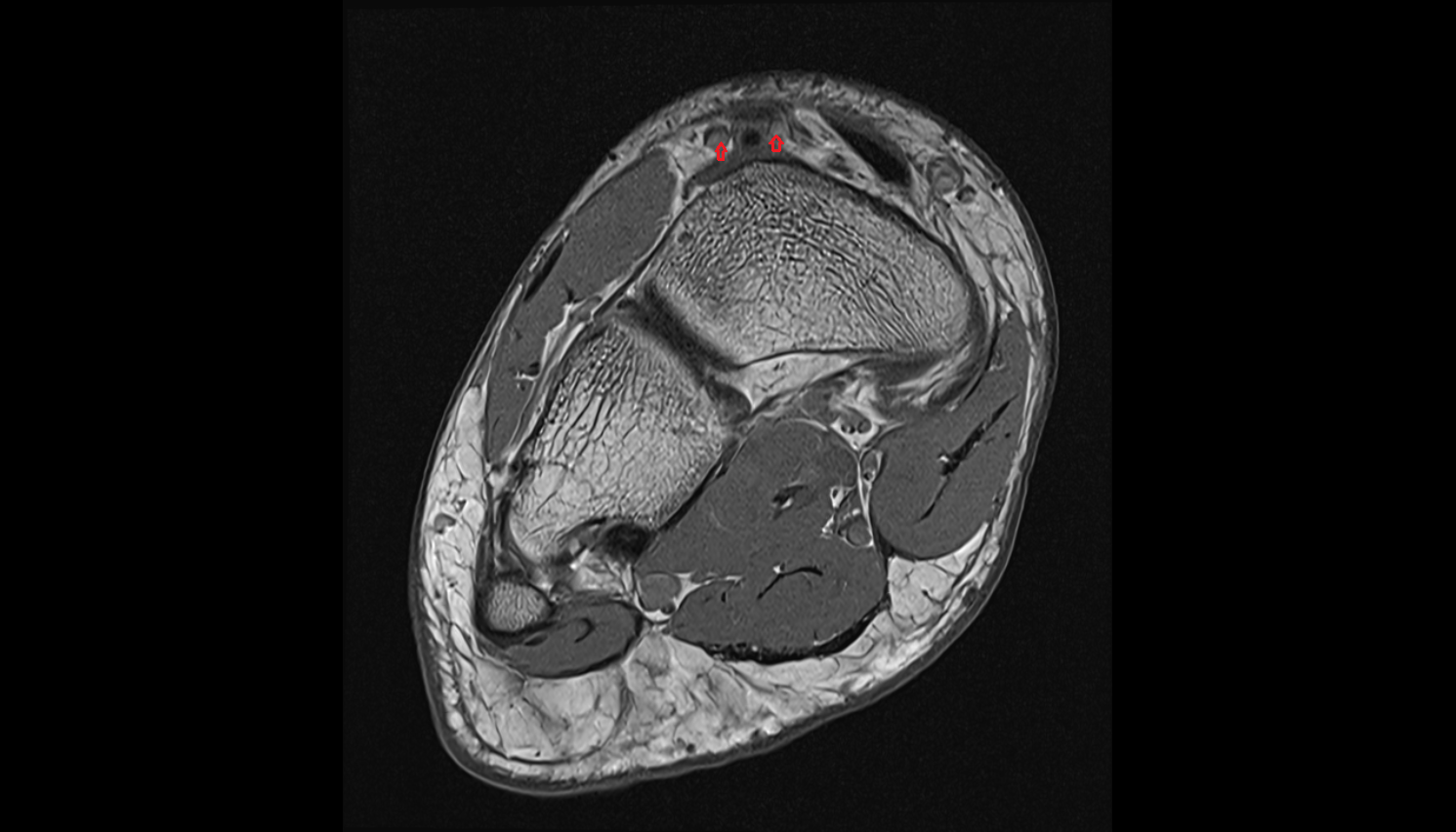 Dorsalis pedis veins  of foot  axial cross sectional anatomy 3T MRI AI enhanced radiology image-img-00000-00000_00001