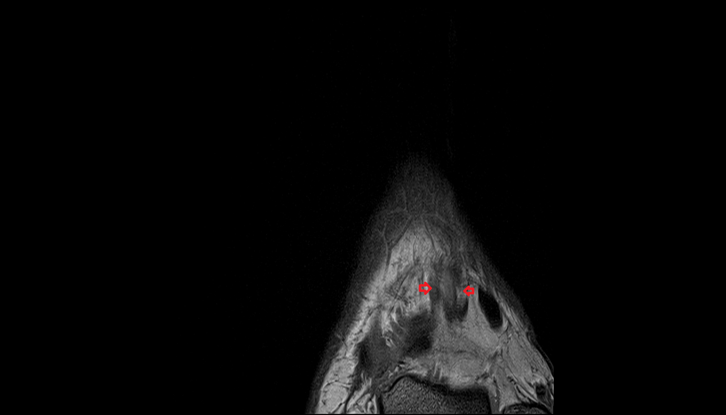 Dorsalis pedis veins  of foot  coronal cross sectional anatomy 3T MRI AI enhanced radiology image-img-00000-00000