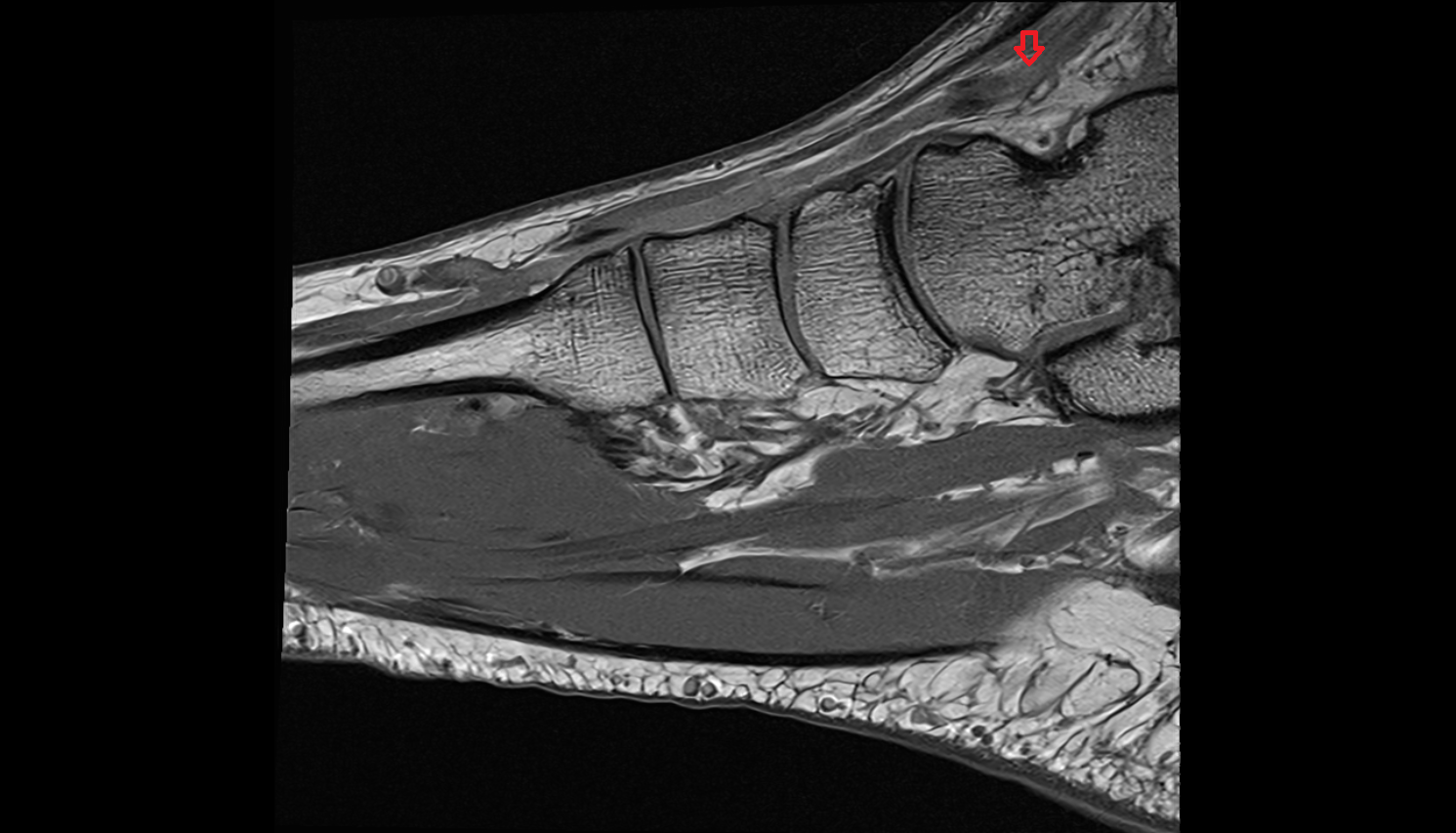 Dorsalis pedis veins  of foot  sag cross sectional anatomy 3T MRI AI enhanced radiology image-img-00000-00000_00002