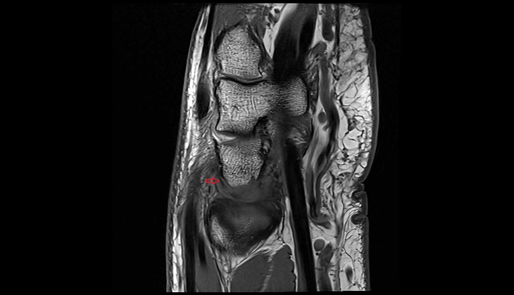 Dorsal lunotriquetral ligament mri sag image