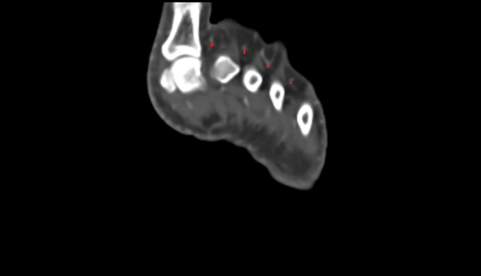 Dorsal metatarsal arteries ct axial