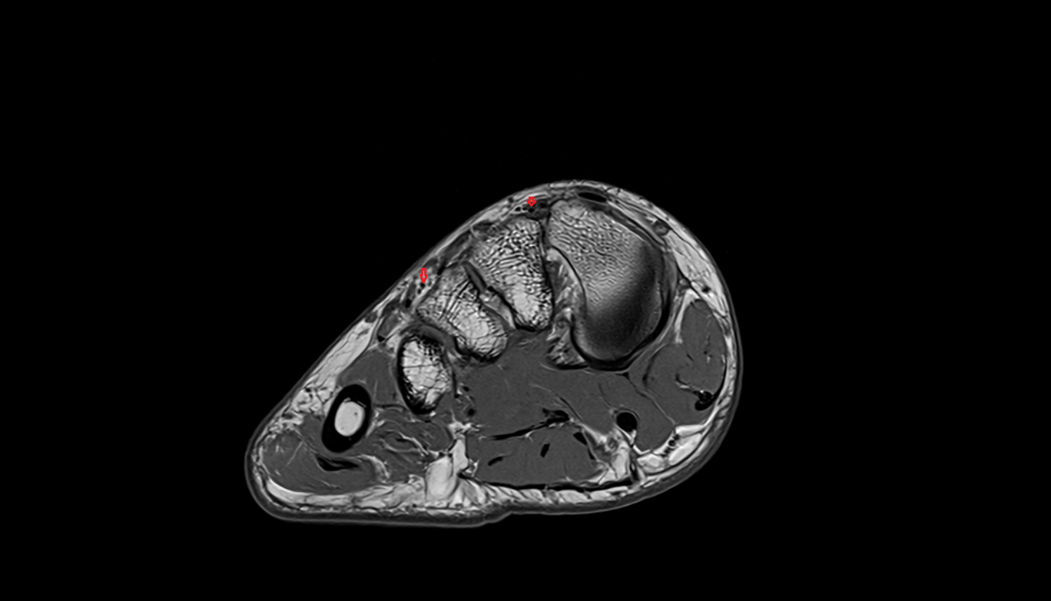 Dorsal metatarsal arteries of foot  sfov  of the Foot axial cross sectional anatomy 3T MRI AI enhanced radiology image-img-00000-00000_00001