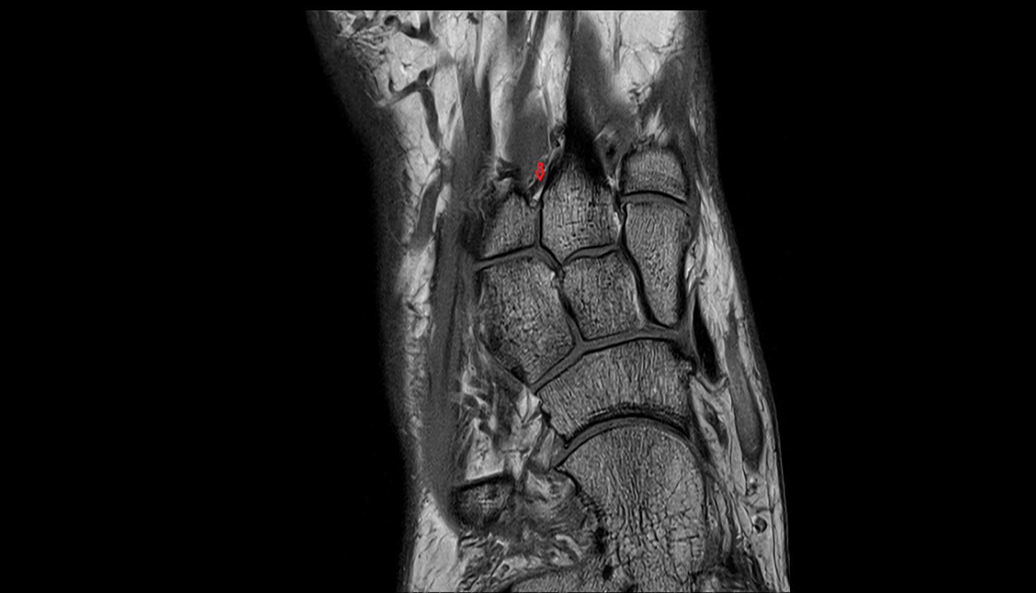Dorsal metatarsal ligaments coronal cross sectional anatomy 3T MRI AI enhanced radiology image-img-00000-00000