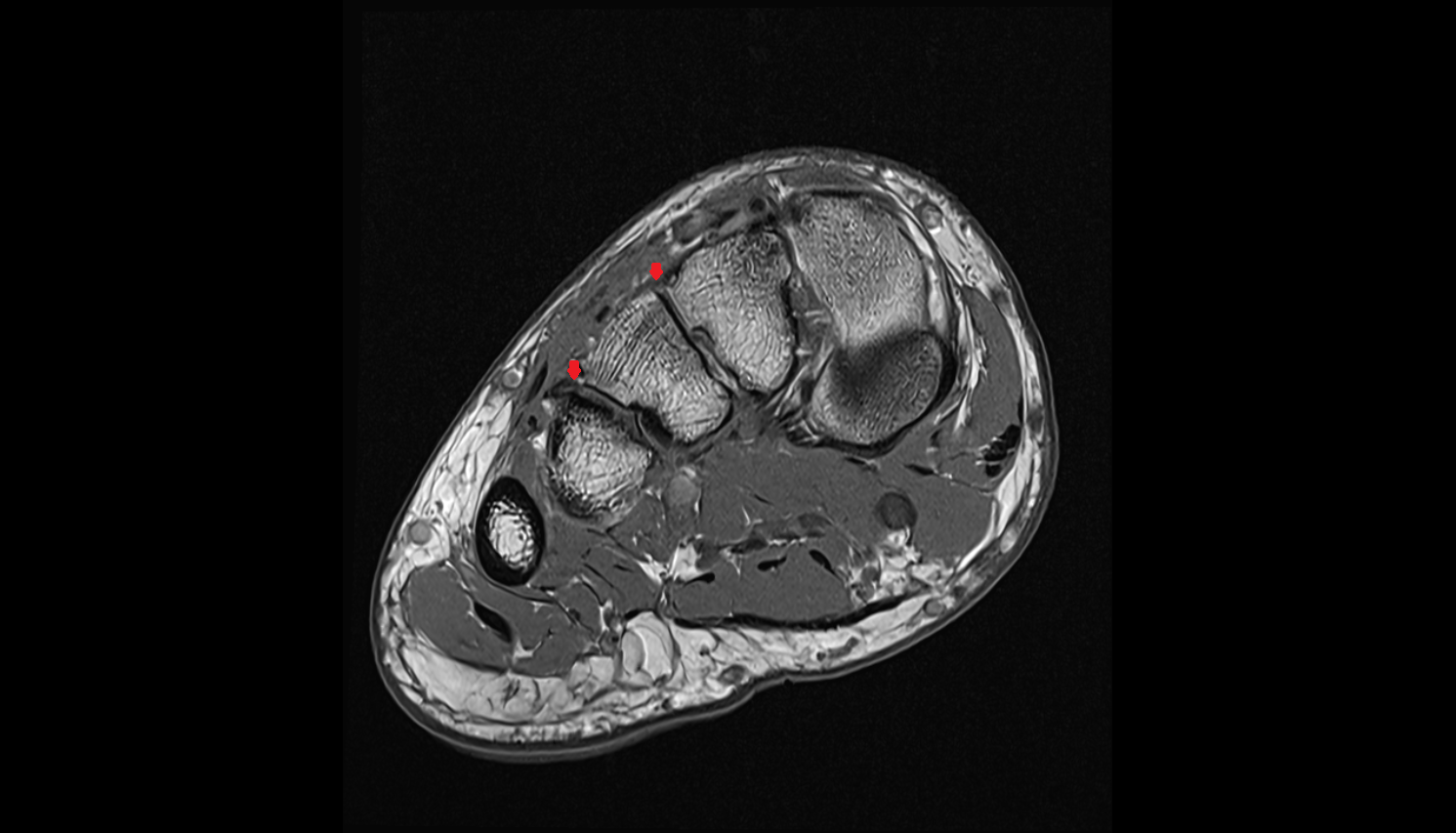 Dorsal metatarsal ligaments coronal cross sectional anatomy 3T MRI AI enhanced radiology image-img-00000-00000_00001