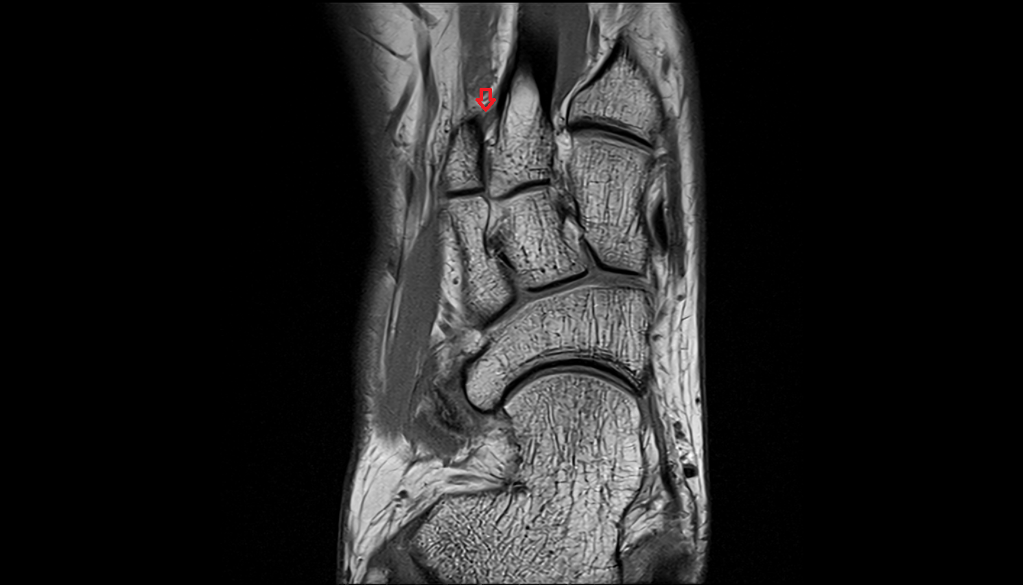 Dorsal metatarsal ligaments coronal cross sectional anatomy 3T MRI AI enhanced radiology image-img-00000-00000_00002