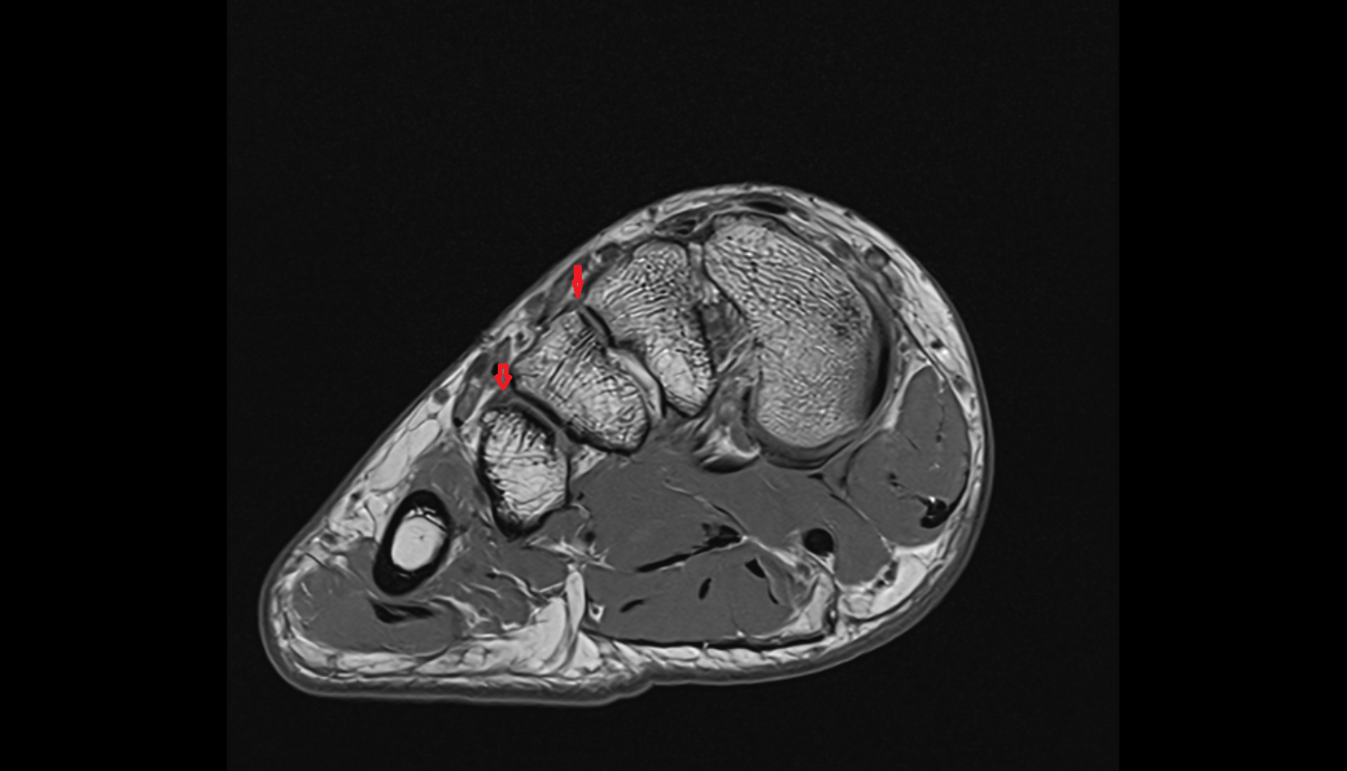 Dorsal metatarsal ligaments coronal cross sectional anatomy 3T MRI AI enhanced radiology image-img-00000-00000_00003