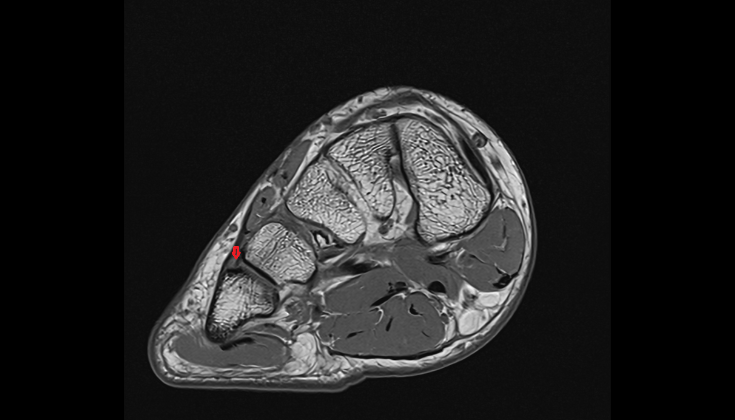 Dorsal metatarsal ligaments coronal cross sectional anatomy 3T MRI AI enhanced radiology image-img-00000-00000_00004