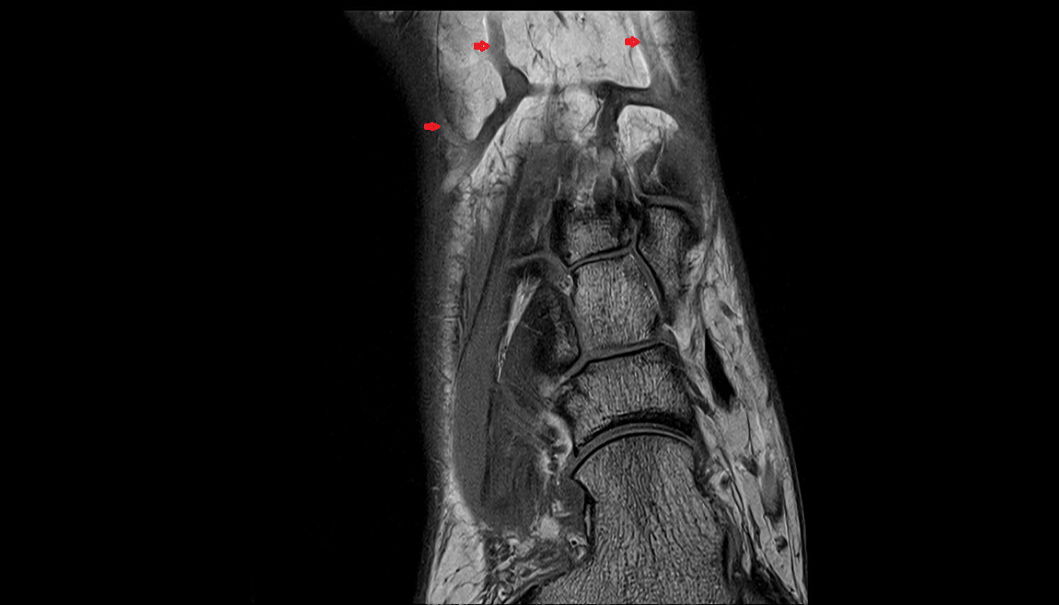 Dorsal metatarsal veins  of foot  axial cross sectional anatomy 3T MRI AI enhanced radiology image-img-00000-00000