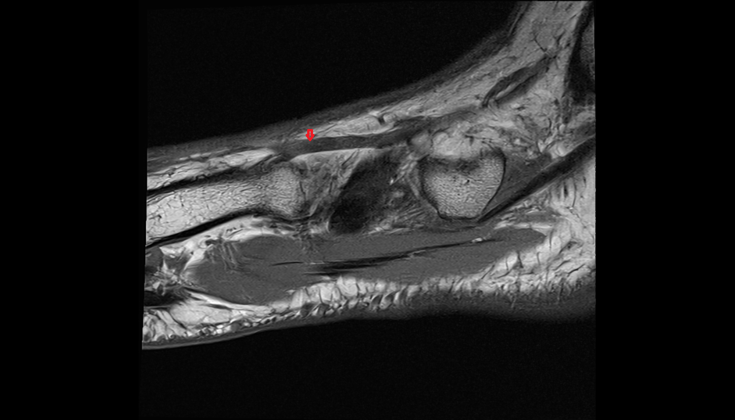 Dorsal metatarsal veins  of foot  sag cross sectional anatomy 3T MRI AI enhanced radiology image-img-00000-00000