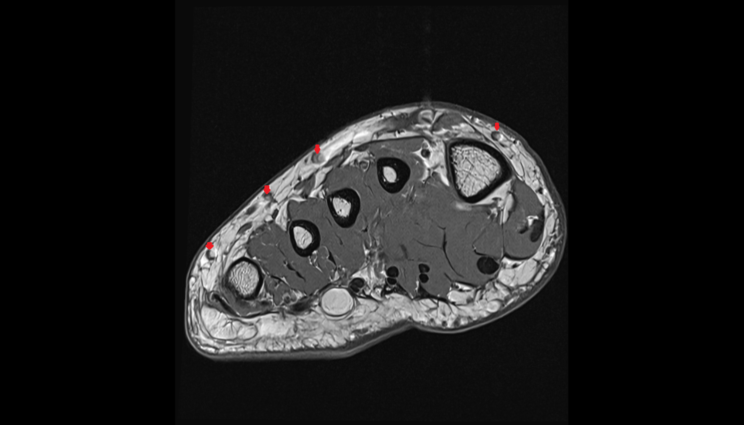 Dorsal metatarsal veins  of foot  sag cross sectional anatomy 3T MRI AI enhanced radiology image-img-00000-00000_00001
