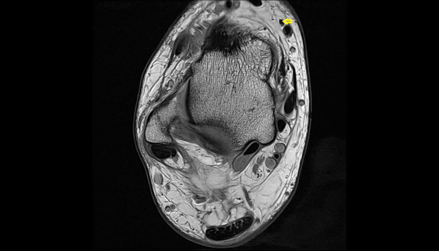 Dorsal perforator veins  AXIAL  cross sectional anatomy 3T MRI AI enhanced radiology image-img-00000-00000